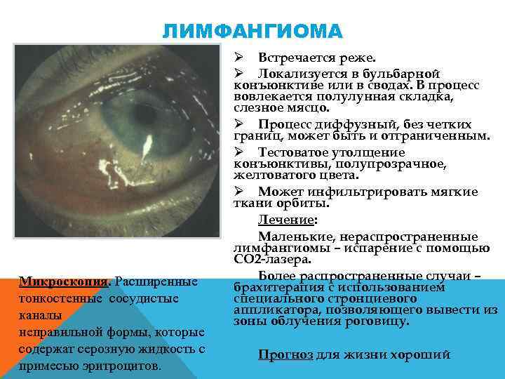 ЛИМФАНГИОМА Микроскопия. Расширенные тонкостенные сосудистые каналы неправильной формы, которые содержат серозную жидкость с примесью