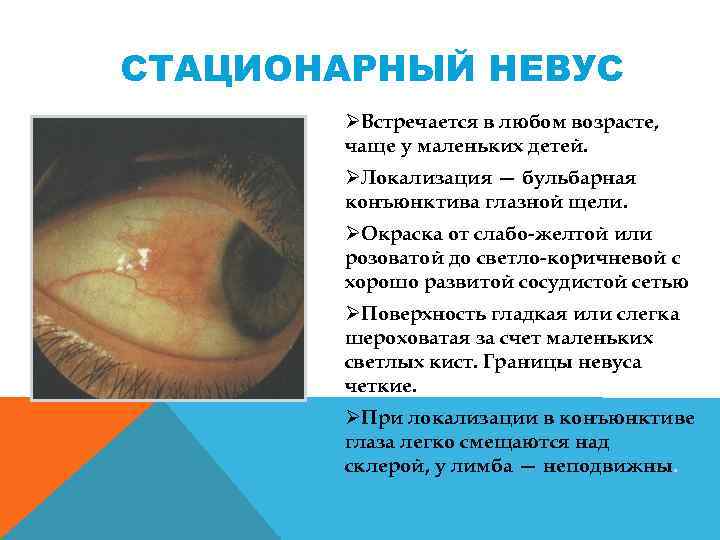 СТАЦИОНАРНЫЙ НЕВУС ØВстречается в любом возрасте, чаще у маленьких детей. ØЛокализация — бульбарная конъюнктива