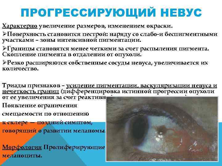 ПРОГРЕССИРУЮЩИЙ НЕВУС Характерно увеличение размеров, изменением окраски. ØПоверхность становится пестрой: наряду со слабо и