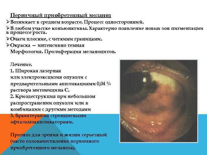 Первичный приобретенный меланоз ØВозникает в среднем возрасте. Процесс односторонний. ØВ любом участке конъюнктивы. Характерно