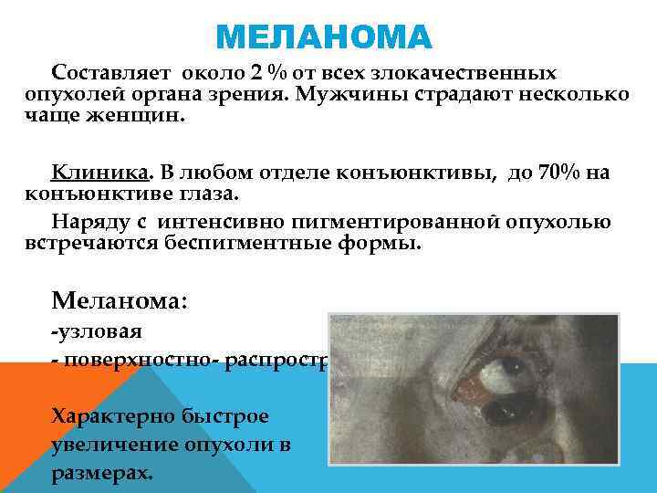 МЕЛАНОМА Составляет около 2 % от всех злокачественных опухолей органа зрения. Мужчины страдают несколько