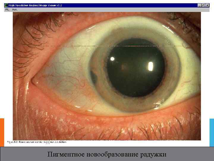 Пигментное новообразование радужки 