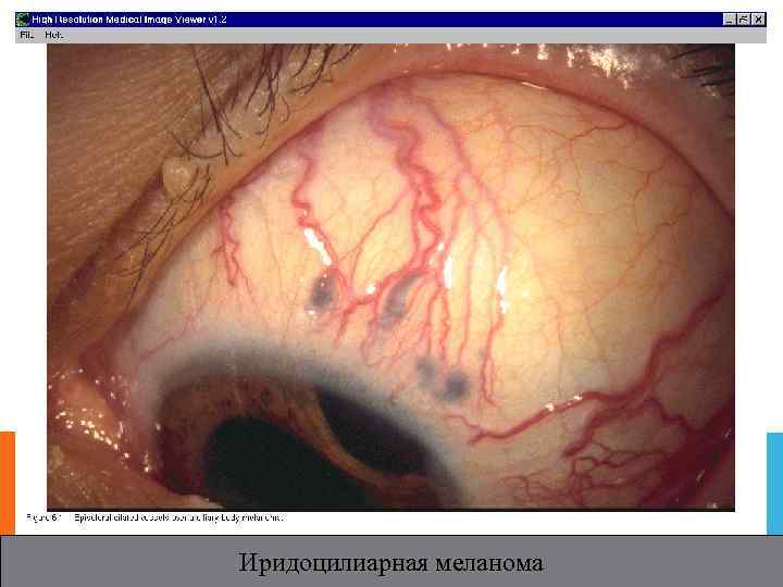Иридоцилиарная меланома 