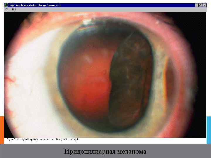 Иридоцилиарная меланома 