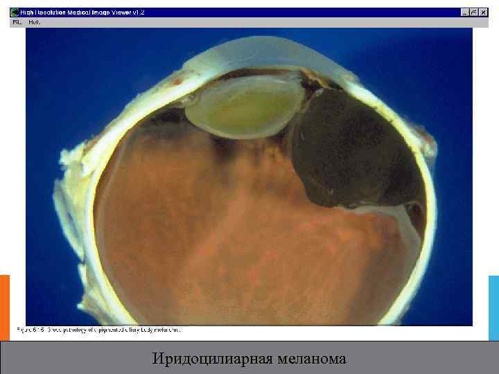 Иридоцилиарная меланома 