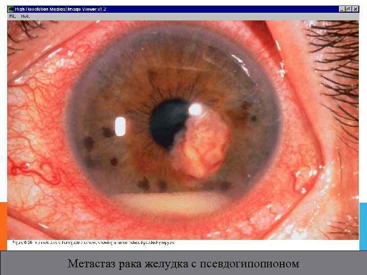 Метастаз рака желудка с псевдогипопионом 
