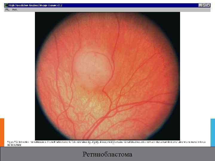 Ретинобластома 