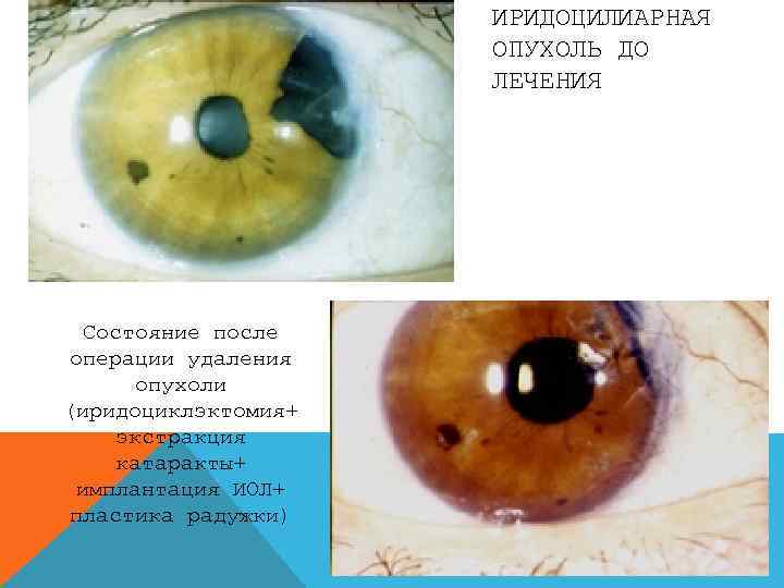 ИРИДОЦИЛИАРНАЯ ОПУХОЛЬ ДО ЛЕЧЕНИЯ Состояние после операции удаления опухоли (иридоциклэктомия+ экстракция катаракты+ имплантация ИОЛ+