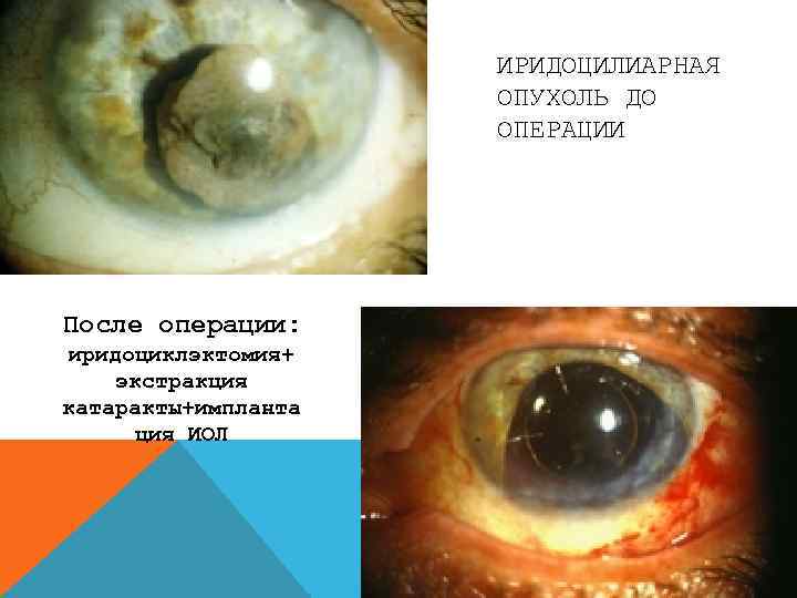 ИРИДОЦИЛИАРНАЯ ОПУХОЛЬ ДО ОПЕРАЦИИ После операции: иридоциклэктомия+ экстракция катаракты+импланта ция ИОЛ 