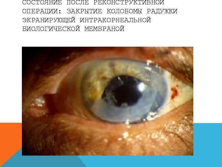 СОСТОЯНИЕ ПОСЛЕ РЕКОНСТРУКТИВНОЙ ОПЕРАЦИИ: ЗАКРЫТИЕ КОЛОБОМЫ РАДУЖКИ ЭКРАНИРУЮЩЕЙ ИНТРАКОРНЕАЛЬНОЙ БИОЛОГИЧЕСКОЙ МЕМБРАНОЙ 