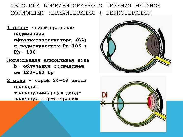 МЕТОДИКА КОМБИНИРОВАННОГО ЛЕЧЕНИЯ МЕЛАНОМ ХОРИОИДЕИ (БРАХИТЕРАПИЯ + ТЕРМОТЕРАПИЯ) 1 этап- эписклеральное подшивание офтальмоаппликатора (ОА)