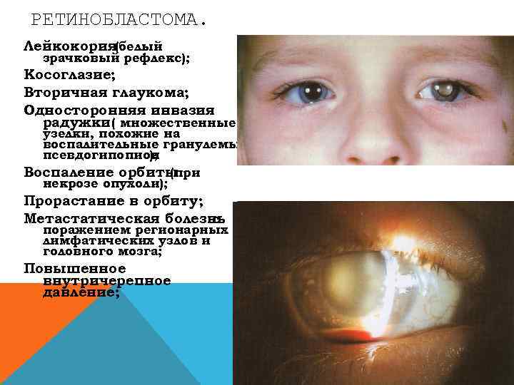РЕТИНОБЛАСТОМА. Лейкокория(белый зрачковый рефлекс); Косоглазие; Вторичная глаукома; Односторонняя инвазия радужки( множественные узелки, похожие на