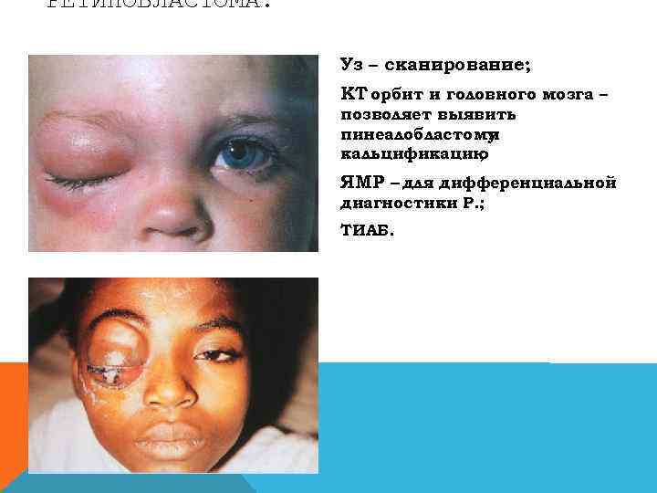 РЕТИНОБЛАСТОМА. Уз – сканирование; КТ орбит и головного мозга – позволяет выявить пинеалобластому и