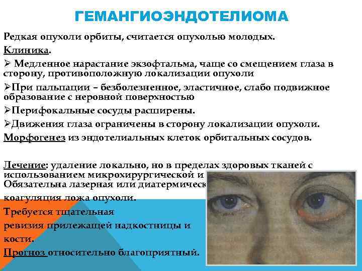 ГЕМАНГИОЭНДОТЕЛИОМА Редкая опухоли орбиты, считается опухолью молодых. Клиника. Ø Медленное нарастание экзофтальма, чаще со
