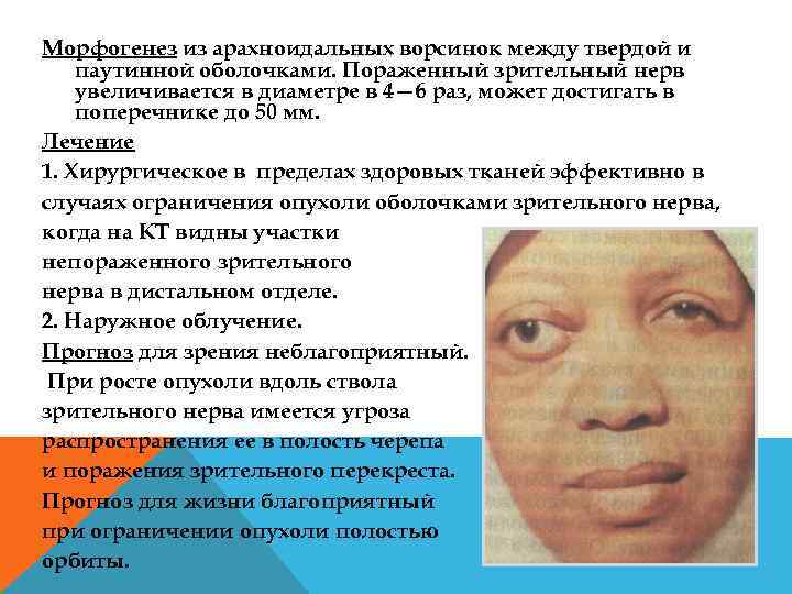 Морфогенез из арахноидальных ворсинок между твердой и паутинной оболочками. Пораженный зрительный нерв увеличивается в