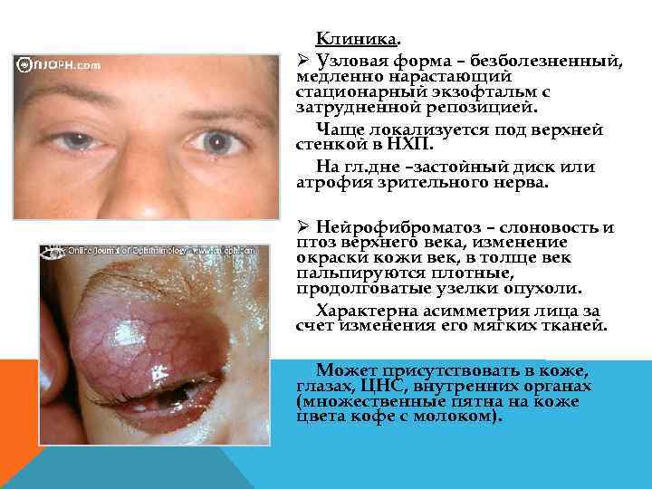 Клиника. Ø Узловая форма – безболезненный, медленно нарастающий стационарный экзофтальм с затрудненной репозицией. Чаще