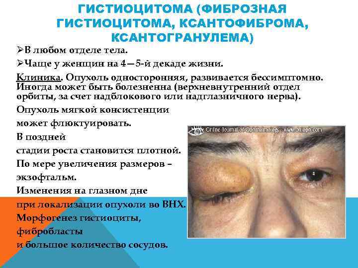 ГИСТИОЦИТОМА (ФИБРОЗНАЯ ГИСТИОЦИТОМА, КСАНТОФИБРОМА, КСАНТОГРАНУЛЕМА) ØВ любом отделе тела. ØЧаще у женщин на 4—