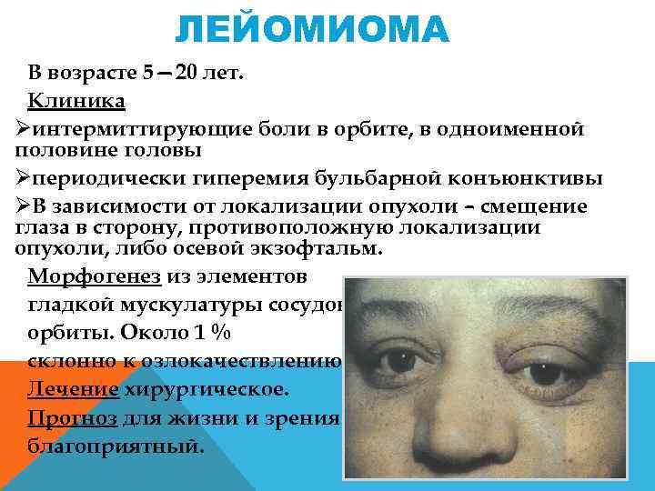ЛЕЙОМИОМА В возрасте 5— 20 лет. Клиника Øинтермиттирующие боли в орбите, в одноименной половине