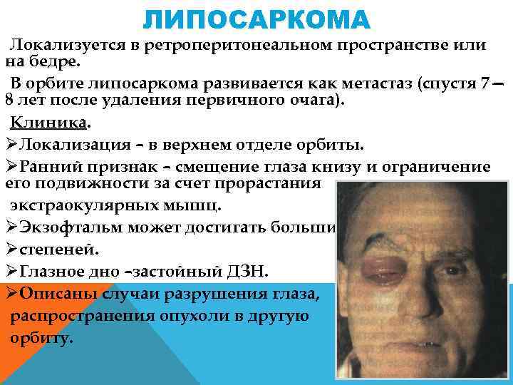 ЛИПОСАРКОМА Локализуется в ретроперитонеальном пространстве или на бедре. В орбите липосаркома развивается как метастаз