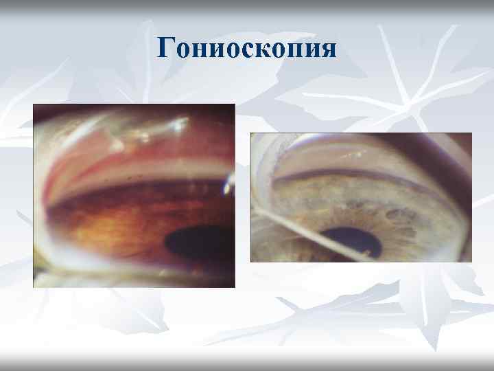 Клиническая картина металлоза глаза может быть вызвана тест