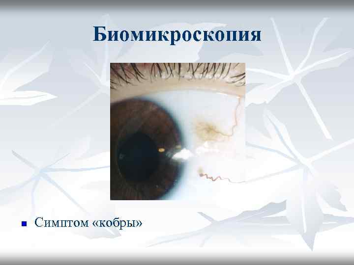 Для открытоугольной глаукомы характерны тест. Биомикроскопия глаза хрусталик. Симптом кобры глаукома. Открытоугольная глаукома симптомы. Биомикроскопия глаза норма.