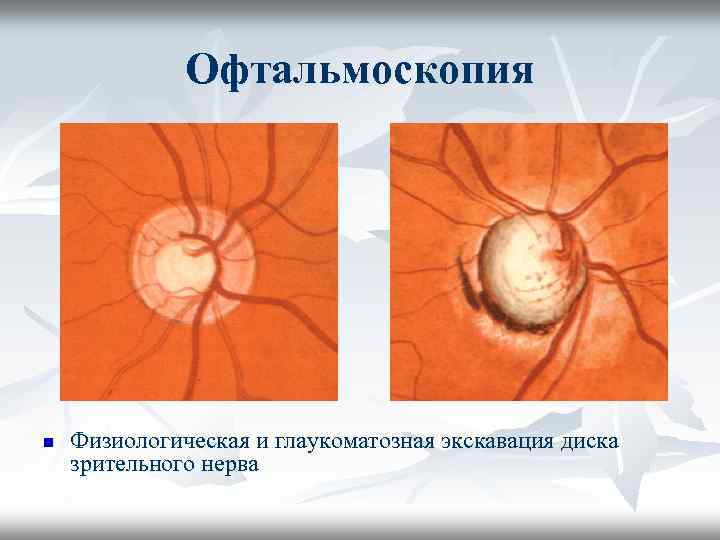 Офтальмоскопия n Физиологическая и глаукоматозная экскавация диска зрительного нерва 