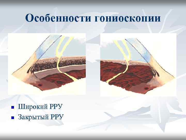 Особенности гониоскопии n n Широкий РРУ Закрытый РРУ 