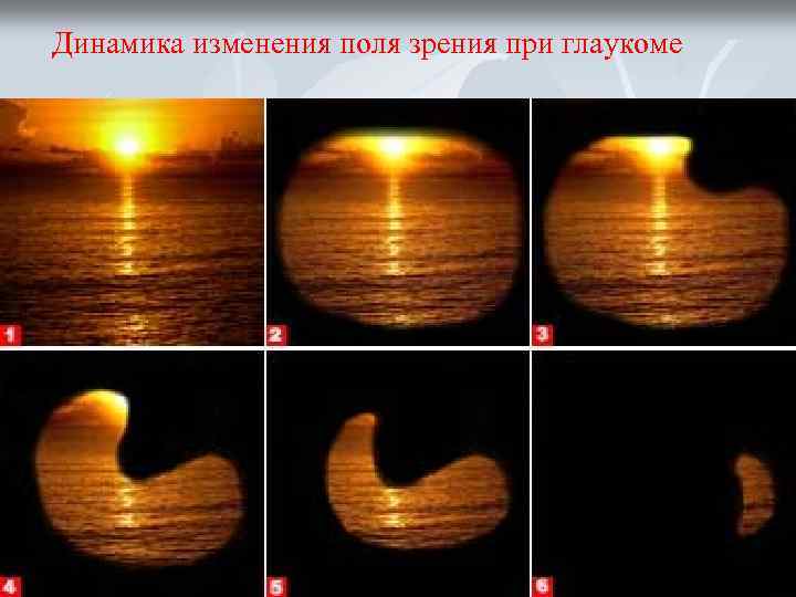 Динамика изменения поля зрения при глаукоме 
