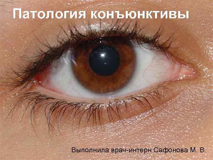 Патология конъюнктивы  Выполнила врач-интерн Сафонова М. В. 