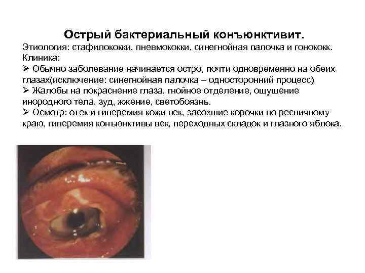       Основные принципы лечения  1. Эвакуация гнойного отделяемого