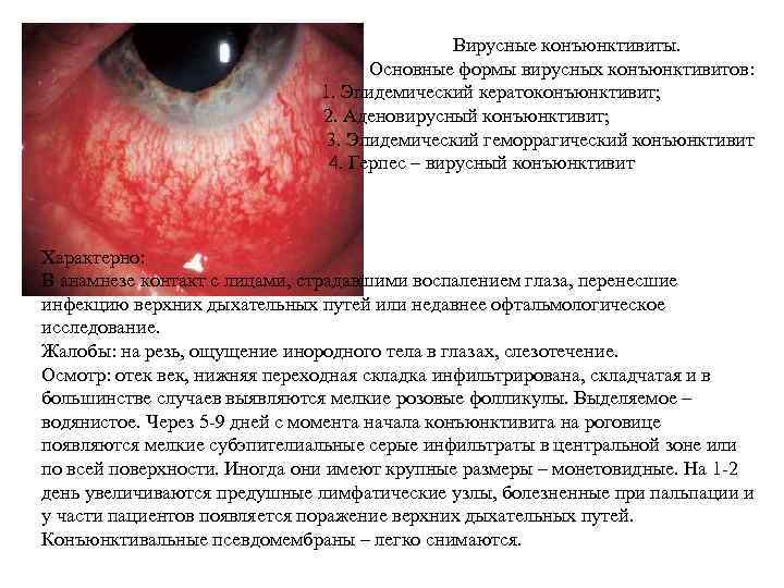  Аденовирусный кератоконъюнктивит 