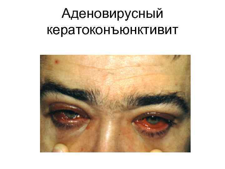        Эпидемический      геморрагический