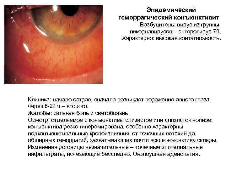  Эпидемический кератоконъюнктивит 