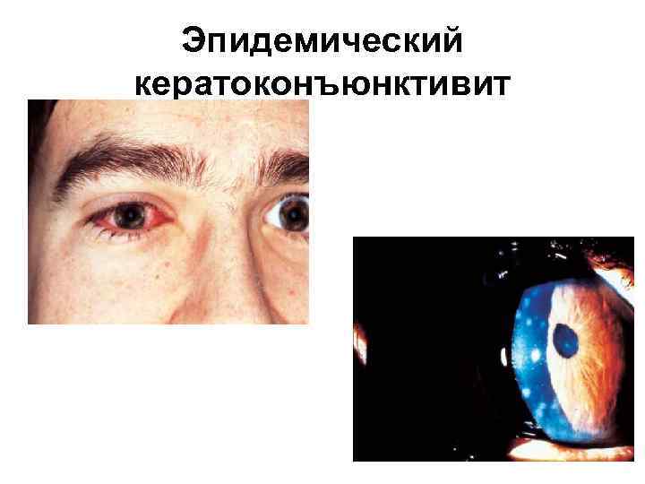 Лечение аденовирусных конъюнктивитов: 1. Интерфероны и интерфероногены Офтальмоферон 6 -8 раз в день в