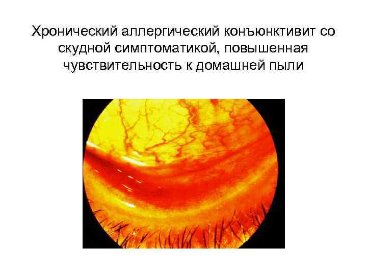 Острый поллинозный конъюнктивит, хемоз   конъюнктивы 
