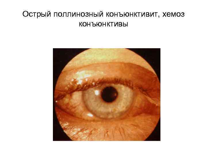 Хронический аллергический поллинозный конъюнктивит с мелкососочковой гипертрофией конъюнктивы верхнего века 