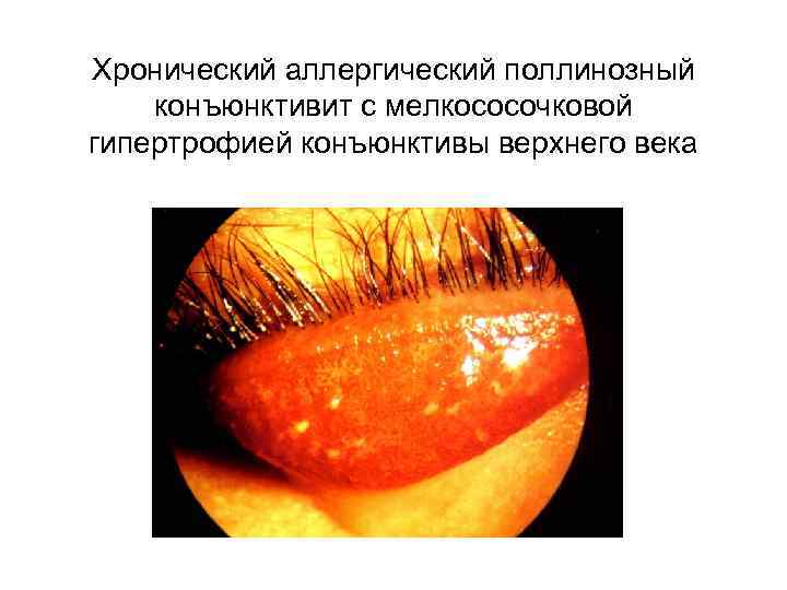    Лечение • Противоаллергические глазные капли  – При остром течении: 