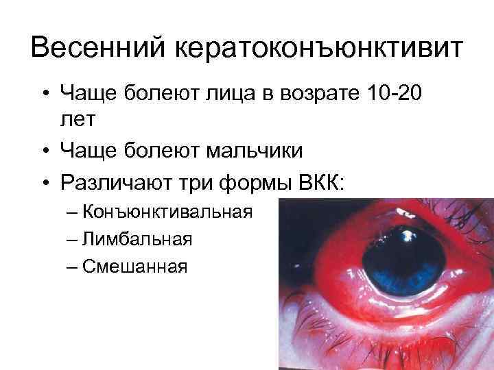     Весенний кератоконъюнктивит Весенний конъюнктивит. Конъюнктива с молочным оттенком,  «булыжная