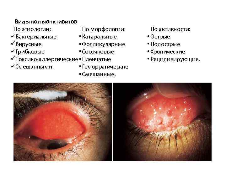 Пленчатый конъюнктивит 