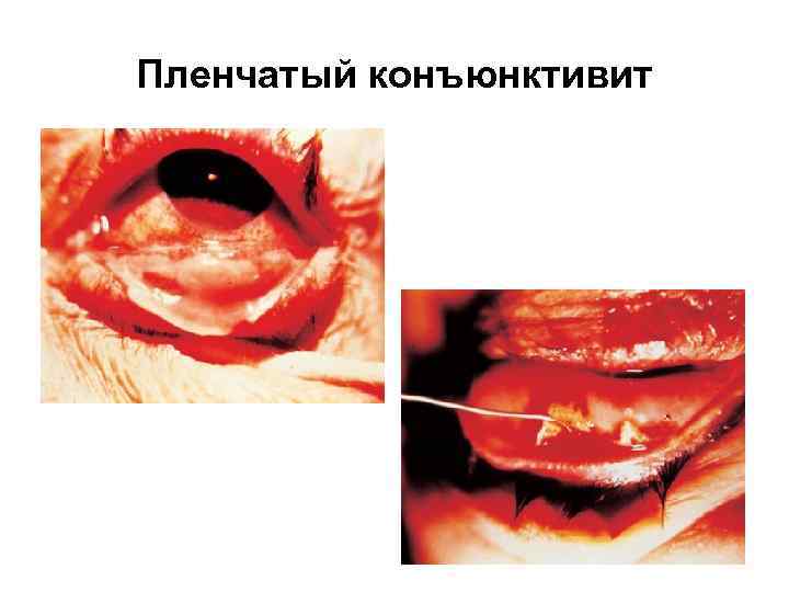  Обследование пациента с   конъюнктивитом 1. Анамнез заболевания. 2. Офтальмологическая  диагностика: