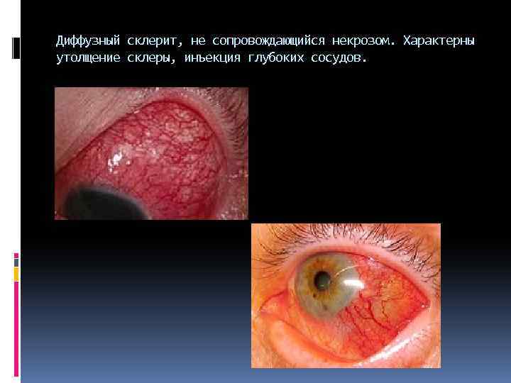 Диффузный склерит, не сопровождающийся некрозом. Характерны утолщение склеры, инъекция глубоких сосудов. 