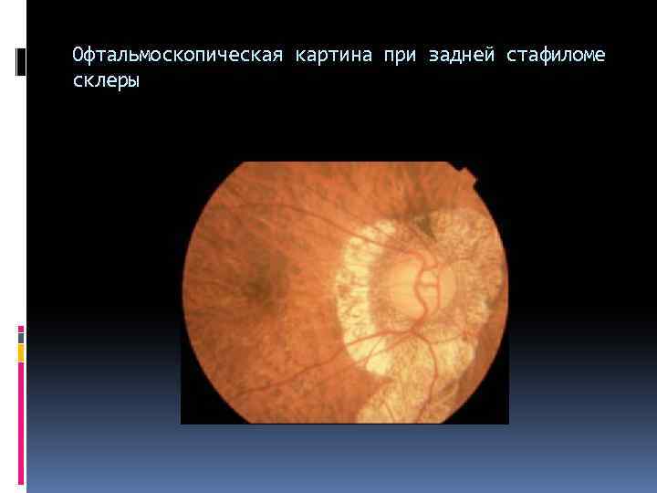 Офтальмоскопическая картина при задней стафиломе склеры 