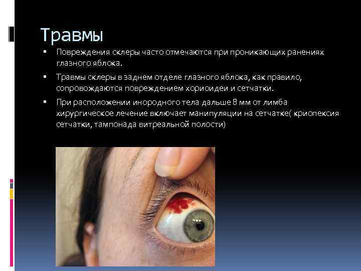 Травмы Повреждения склеры часто отмечаются при проникающих ранениях глазного яблока. Травмы склеры в заднем