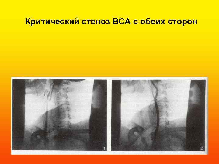Критический стеноз ВСА с обеих сторон 