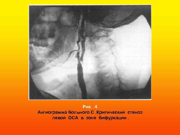 Рис. 4 Ангиограмма больного С. Критический стеноз левой ОСА в зоне бифуркации. 