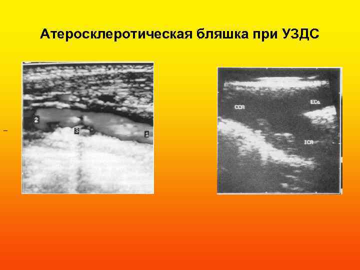 Атеросклеротическая бляшка при УЗДС – 