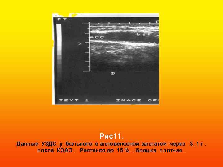Рис11. Данные УЗДС у больного с алловенозной заплатой через 3 , 1 г. после