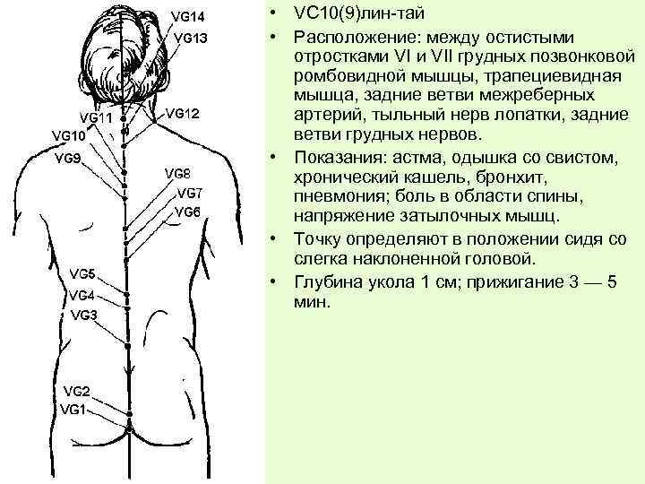  • VС 10(9)лин-тай • Расположение: между остистыми отростками VII грудных позвонковой ромбовидной мышцы,