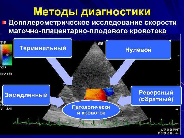 Методы диагностики Допплерометрическое исследование скорости маточно-плацентарно-плодового кровотока Терминальный Нулевой Реверсный (обратный) Замедленный Патологически й