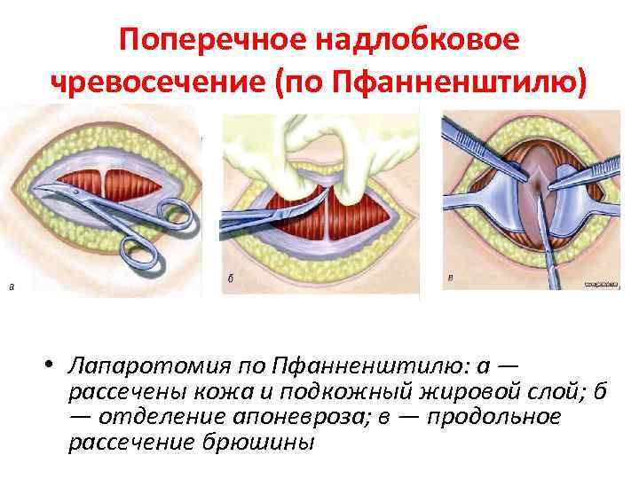 Удаление заднего. Пфанненштилю лапаротомия Пфанненштилю. Разрез Пфанненштилю поперечный. Надлобковый поперечный разрез (по Пфанненштилю) показания. Лапаротомия по Пфанненштилю с иссечением кожного рубца.